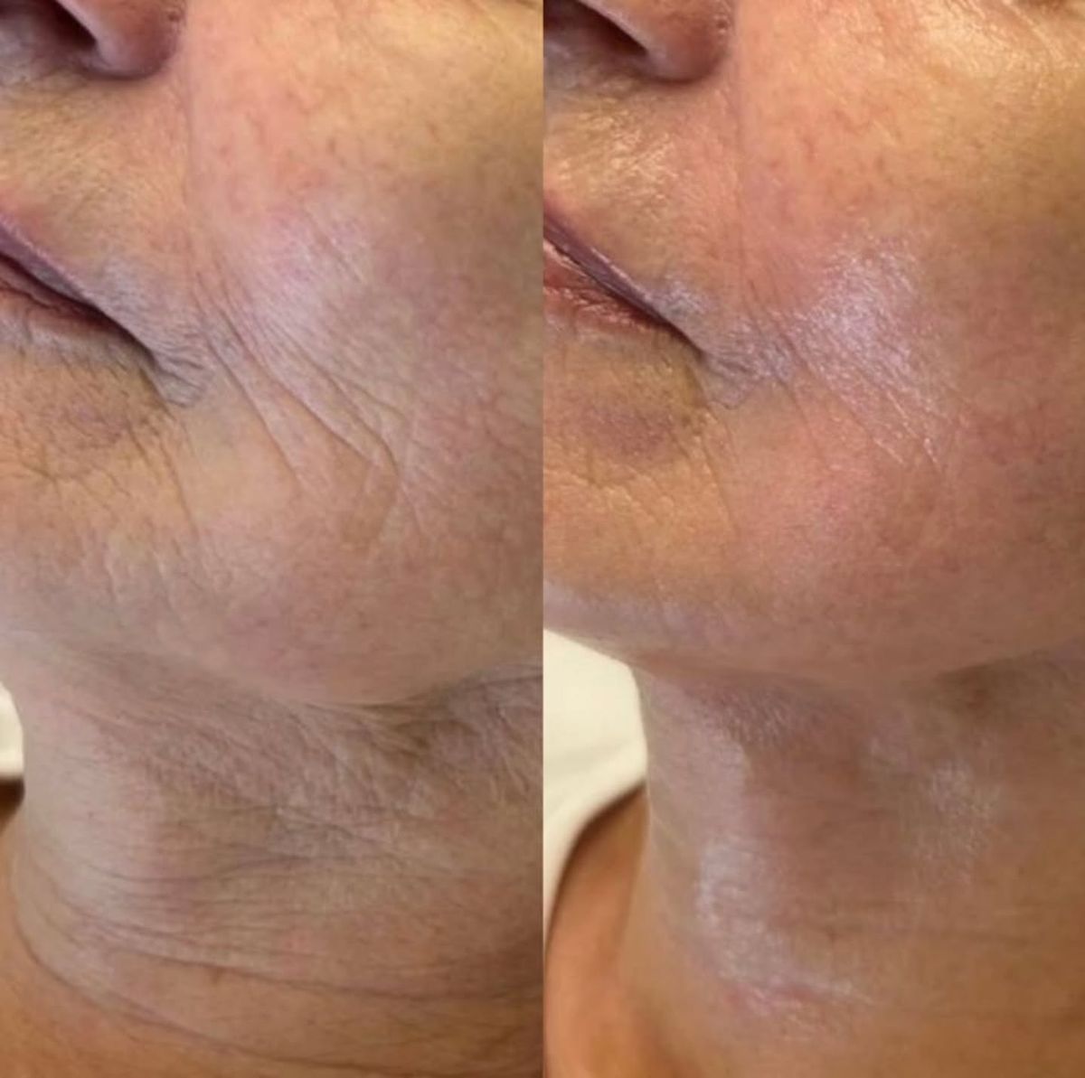 Risultato filler acido ialuronico