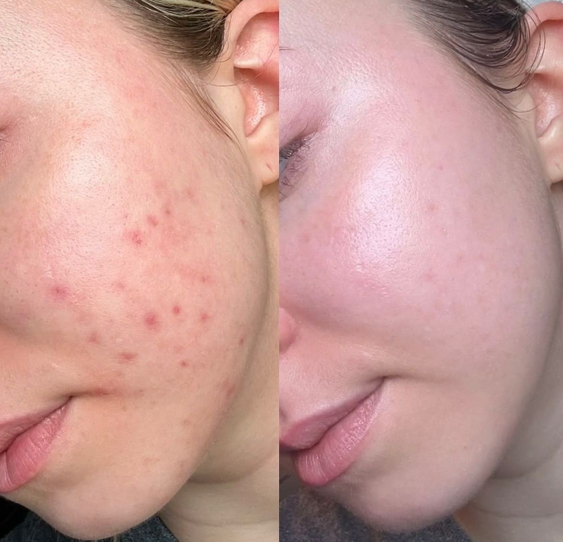 Risultato peeling chimico