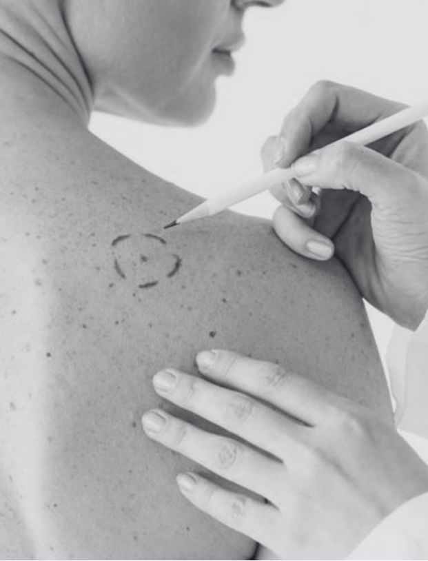 Trattamento laser per nevi