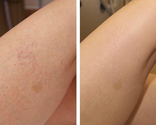 Laser vascolare Nd:YAG